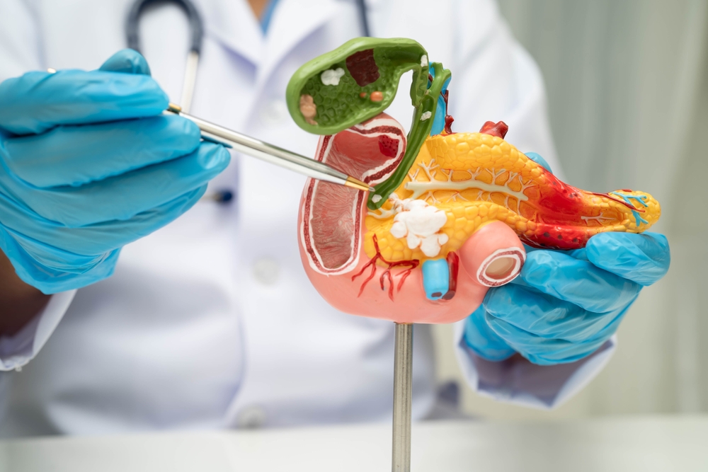 Pancreatitis,,Pancreatic,Cancer,,Asian,Doctor,With,Pancreas,,Gallbladder,And,Bile
