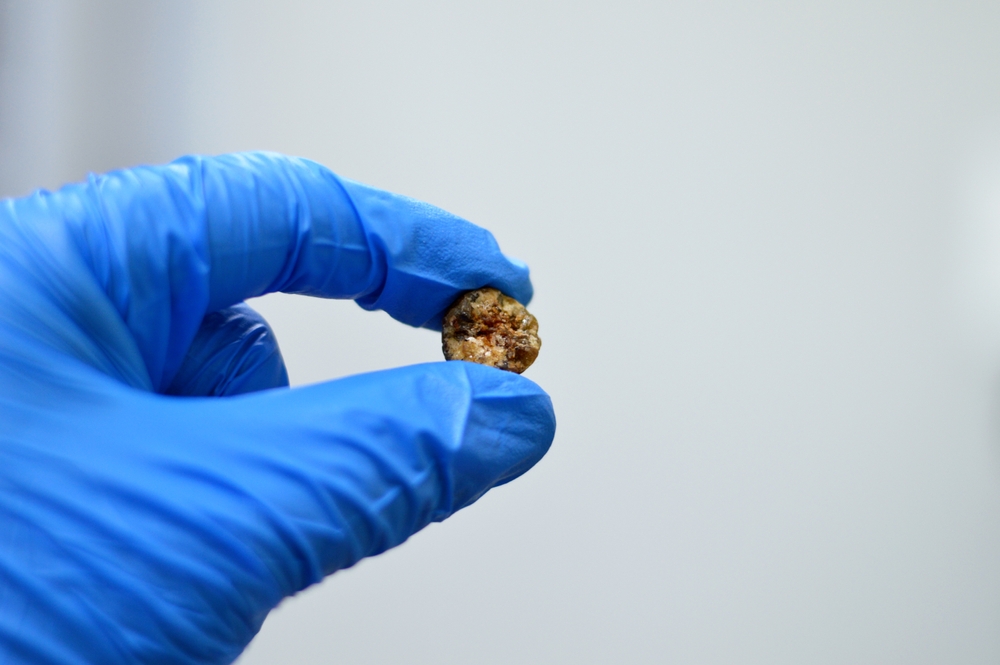 Large,Gallstone,Removed,Surgically,After,Laparoscopic,Cholecystectomy,,Gallstones,Are,Hardened
